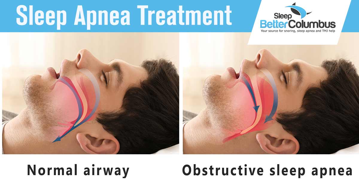 Sleep Better Columbus - a man laying in bed with overlay of a normal airway versus one with obstructive sleep apnea. People are becoming increasingly aware of the effects of sleep apnea on quality of life, but many don't know where to start with treatment options. Your sleep quality may be getting worse, but now is the time to take care of it.